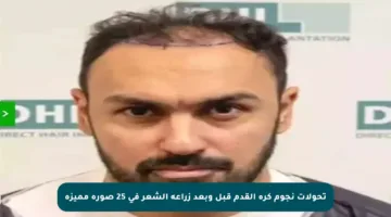 تحولات نجوم كرة القدم قبل وبعد زراعة الشعر في 25 صورة مميزة